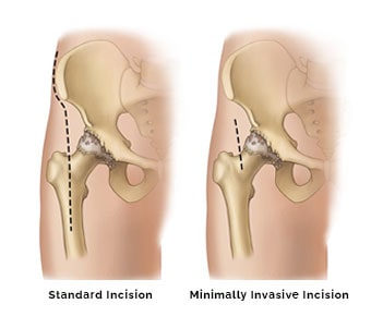 Minimally Invasive Hip and Knee Surgery